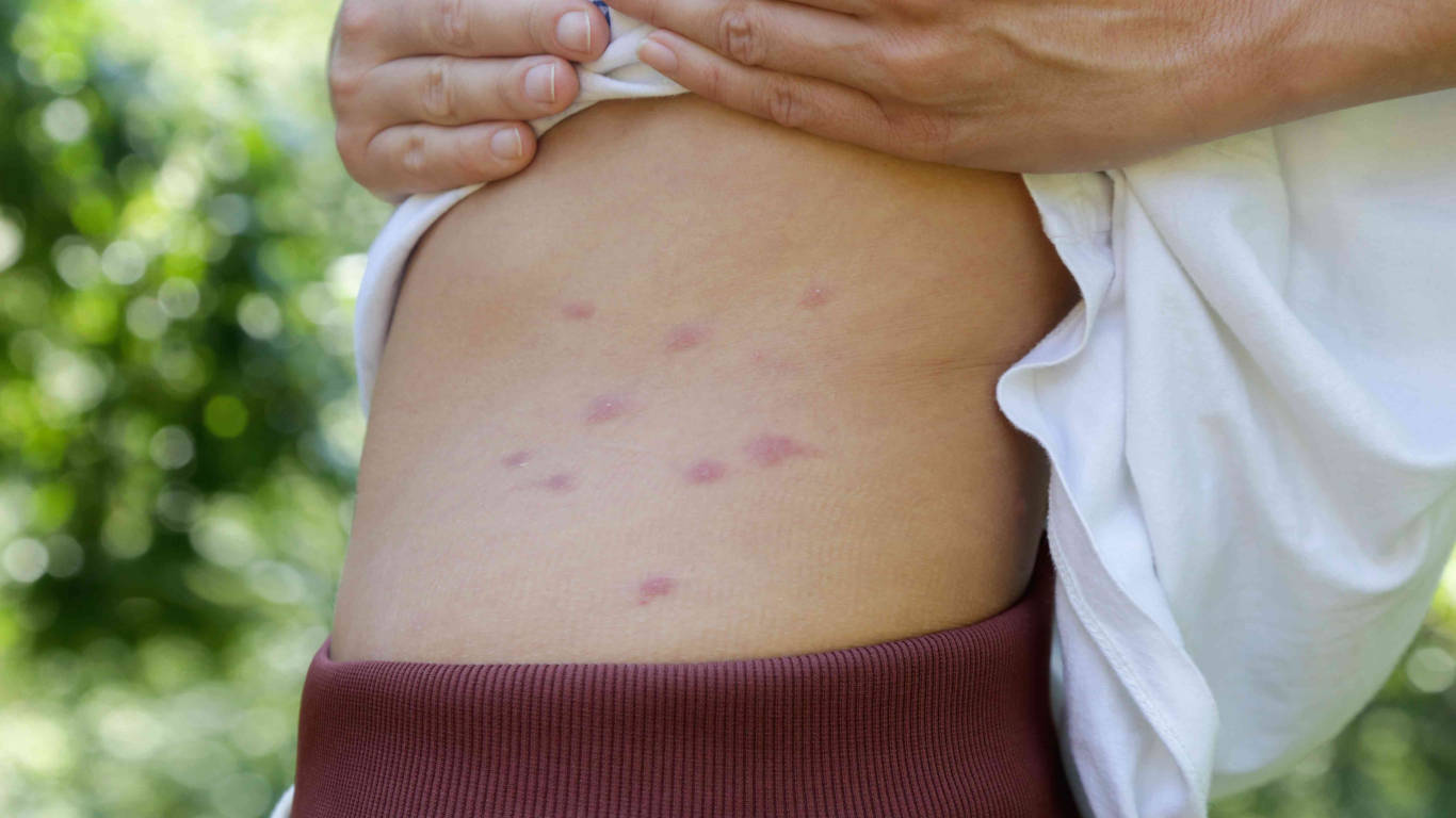 Image of Mosquito Bites